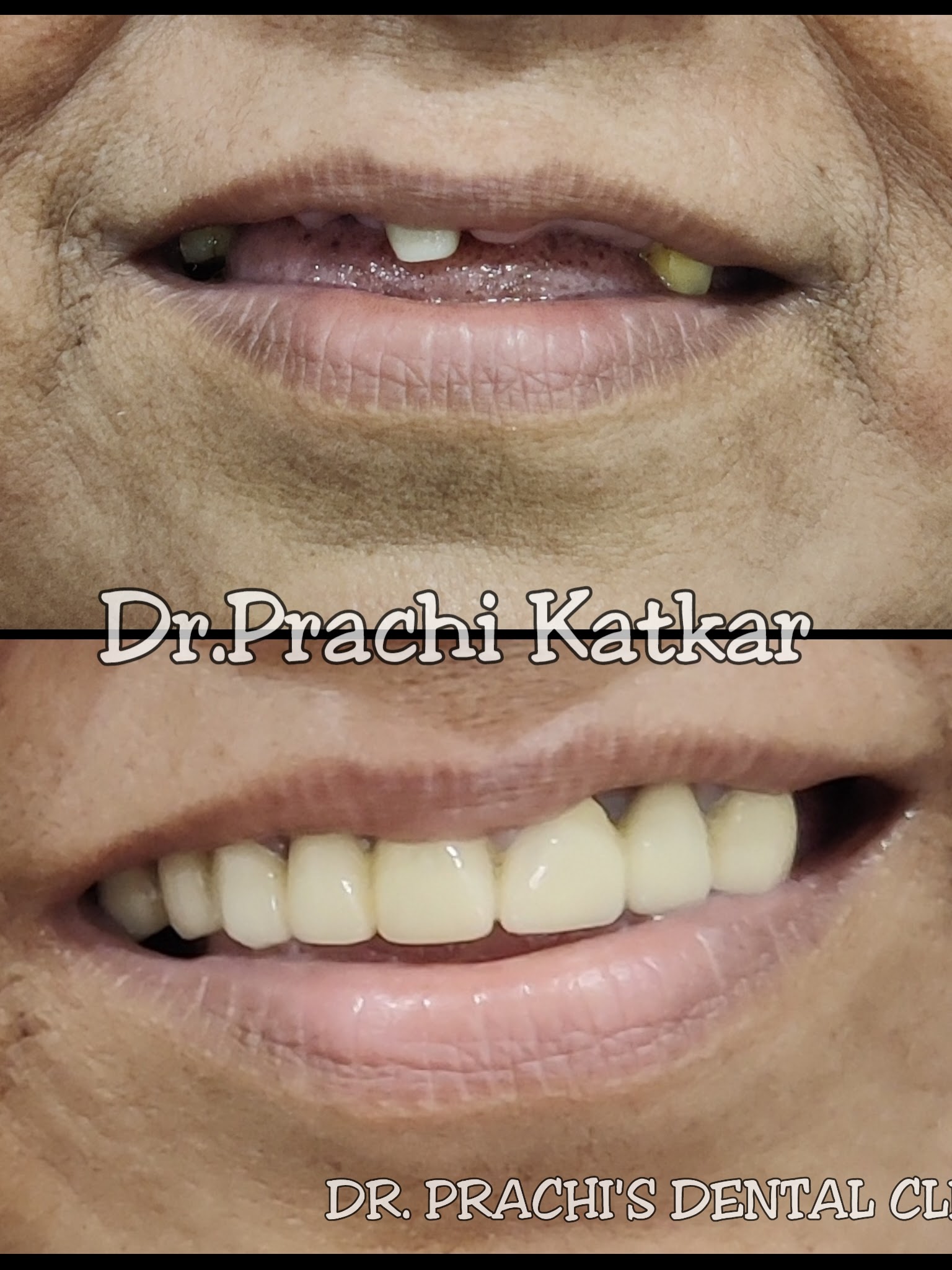 Before and after image showing smile transformation using fixed prosthesis